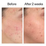 The INKEY List 360 Skin Clearing Serum 30ml